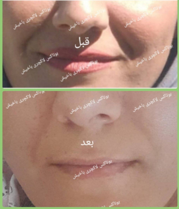 کرم بوتاکس لاکچری باخیش ۴۰ گرم