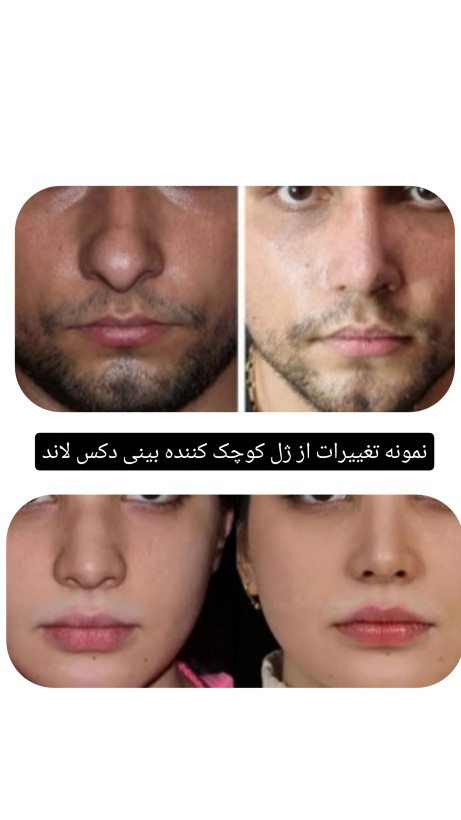 ژل کوچک کننده بینی دکس لاند نمونه اصلی