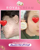 کرم ضدلک قوی ژل رویال آواطب ۲۰ گرم نمونه اصل برای آقایان و بانوان