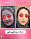 کرم ضدلک قوی ژل رویال آواطب ۲۰ گرم نمونه اصل برای آقایان و بانوان