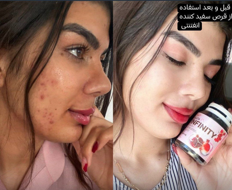 مکمل سفید کننده گلوتا اینفینیتی | گلوتاتیون دوز 1000 نسخه اصلی