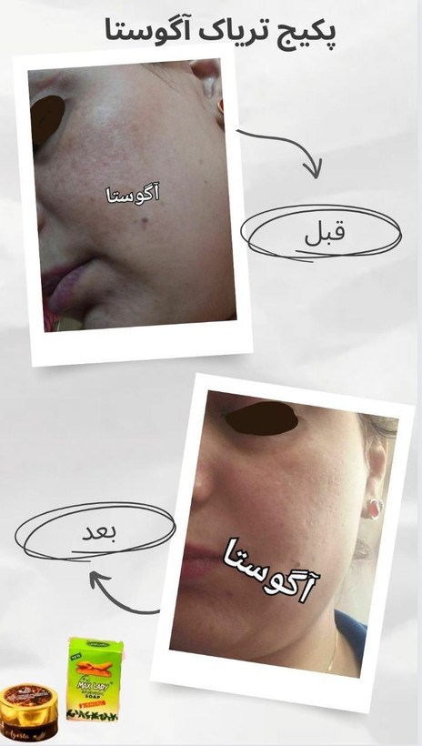 کرم ضدلک و ضدجوش قوی آگوستا
